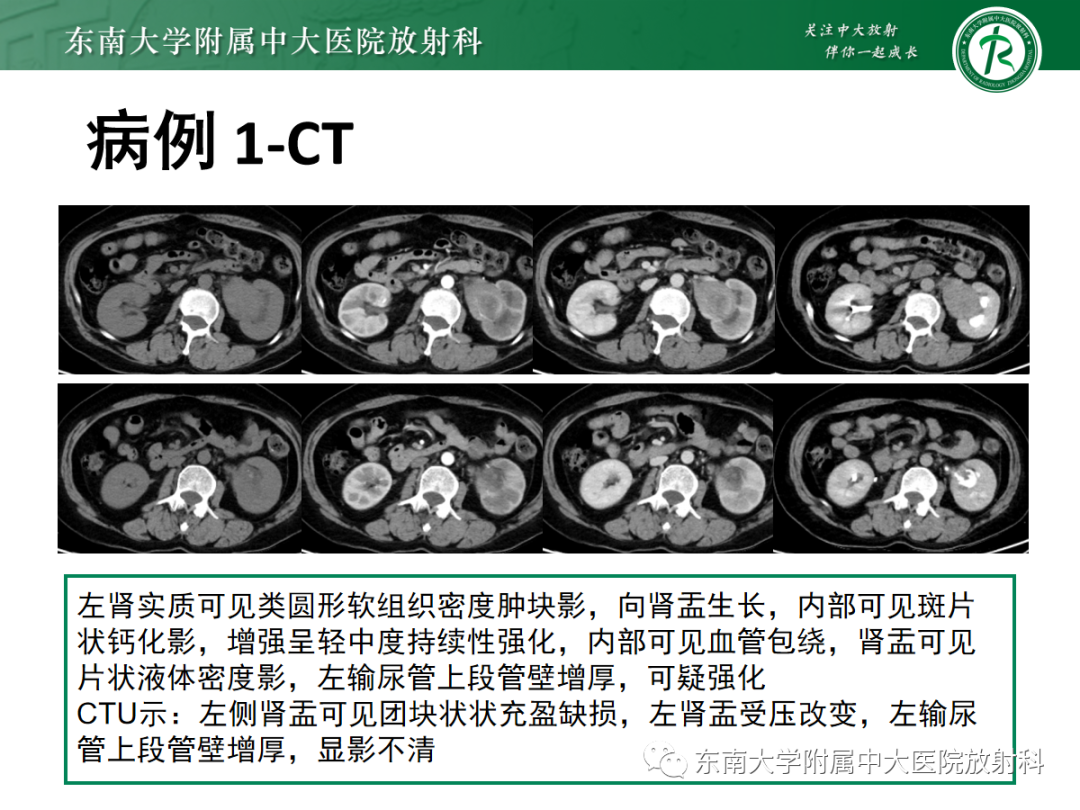 【PPT】肾盂癌-3