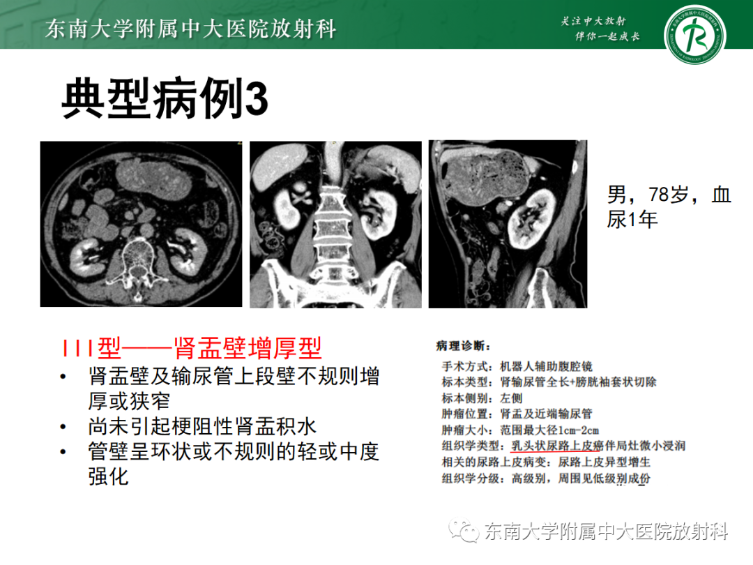 【PPT】肾盂癌-12