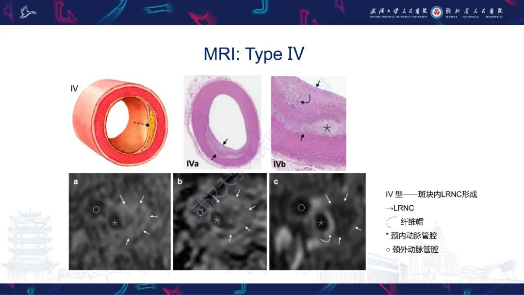 【PPT】颈动脉斑块HR-MR影像判读-28