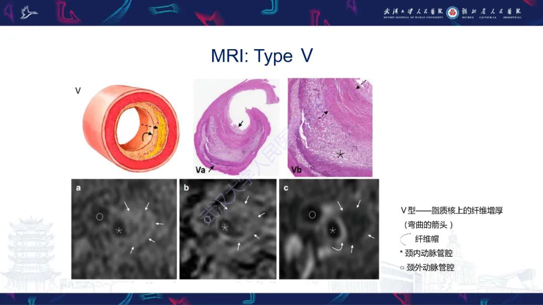 【PPT】颈动脉斑块HR-MR影像判读-29