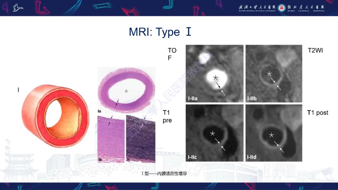 【PPT】颈动脉斑块HR-MR影像判读-25