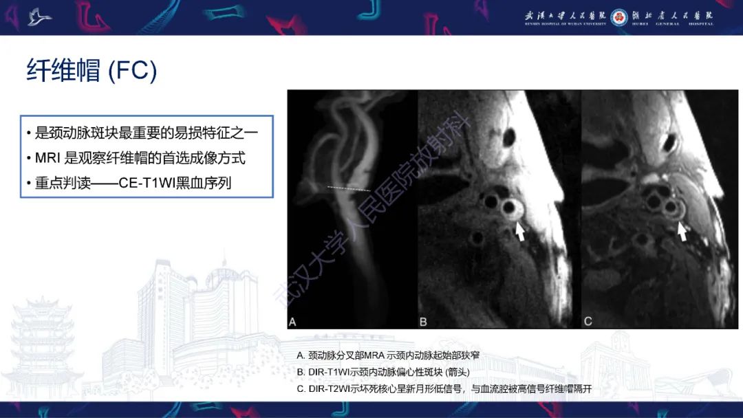 【PPT】颈动脉斑块HR-MR影像判读-16