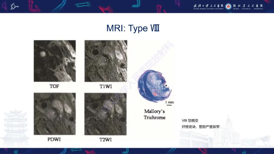 【PPT】颈动脉斑块HR-MR影像判读-32