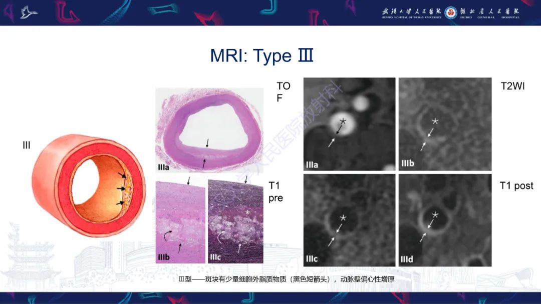 【PPT】颈动脉斑块HR-MR影像判读-27