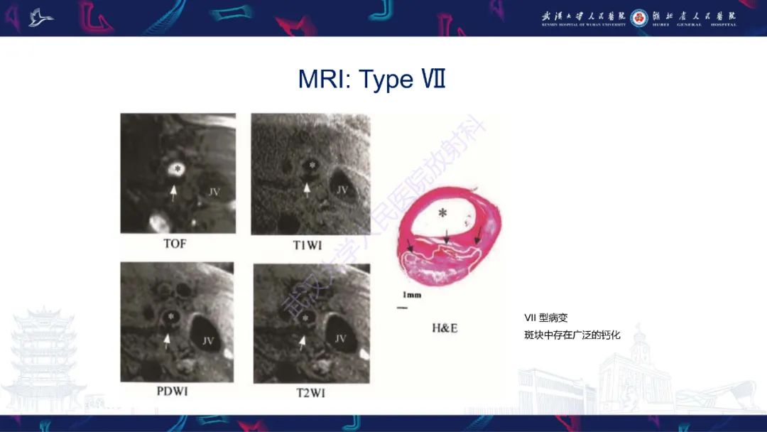 【PPT】颈动脉斑块HR-MR影像判读-31