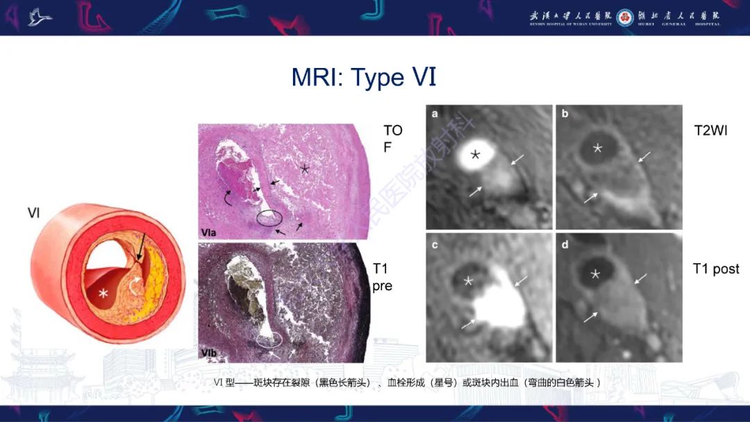 【PPT】颈动脉斑块HR-MR影像判读-30