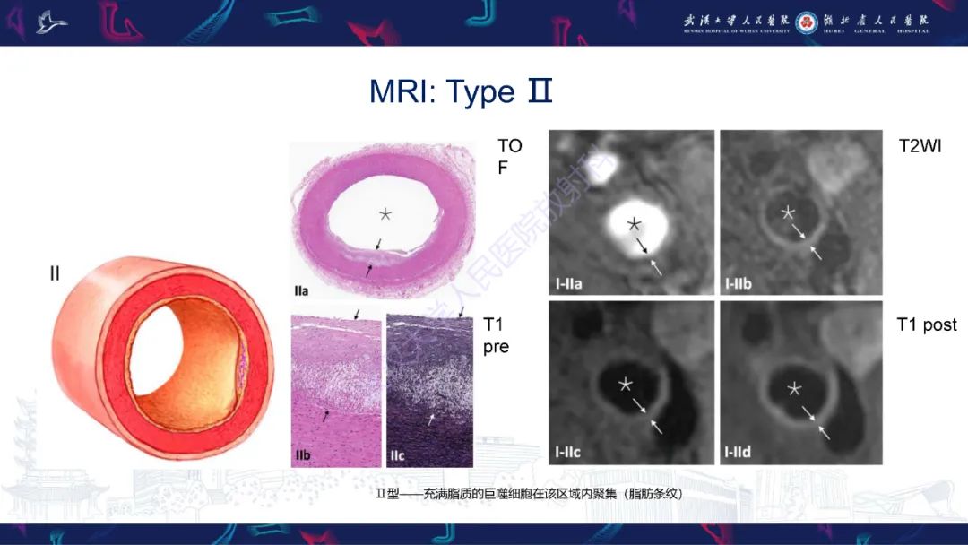 【PPT】颈动脉斑块HR-MR影像判读-26