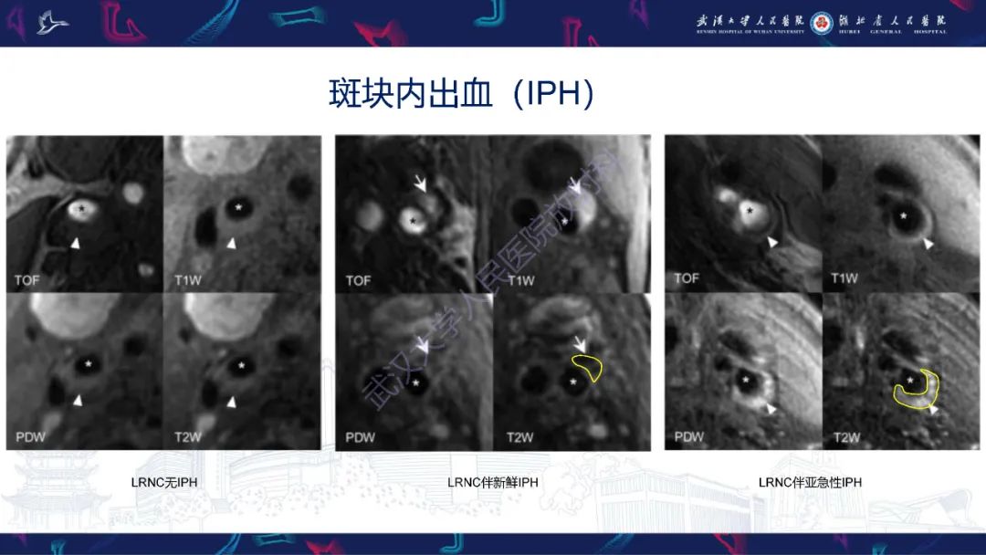 【PPT】颈动脉斑块HR-MR影像判读-21