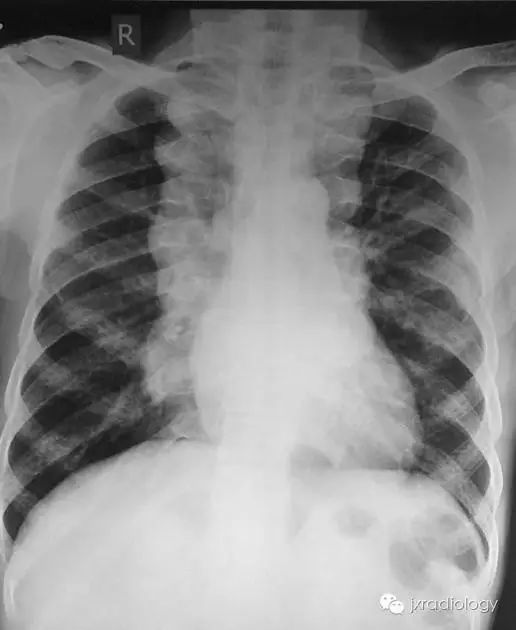 纵隔糖葫芦征—髓外造血-1