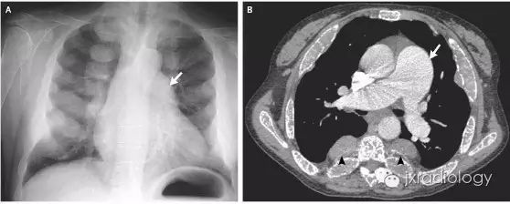 纵隔糖葫芦征—髓外造血-4
