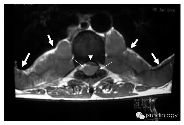 纵隔糖葫芦征—髓外造血-2