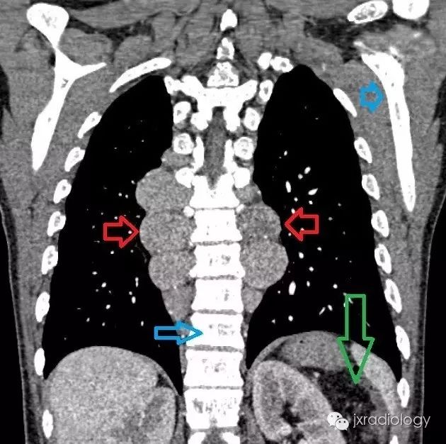 纵隔糖葫芦征—髓外造血-3
