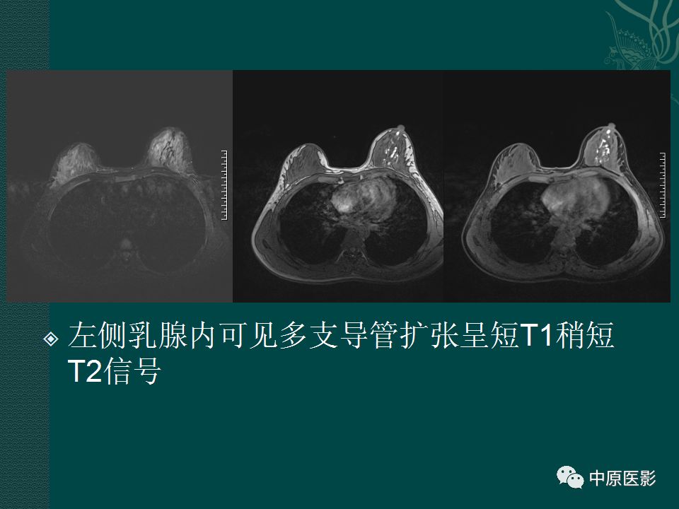 【PPT】乳腺导管内乳头状瘤MRI表现-33