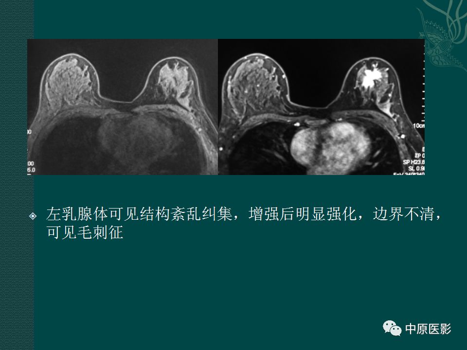 【PPT】乳腺导管内乳头状瘤MRI表现-46
