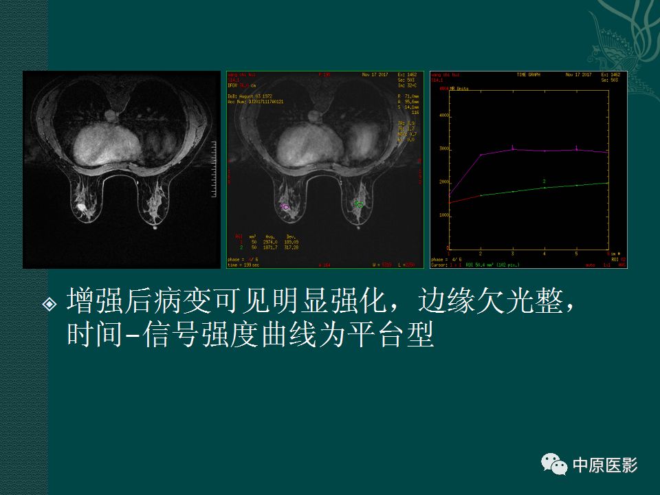【PPT】乳腺导管内乳头状瘤MRI表现-18