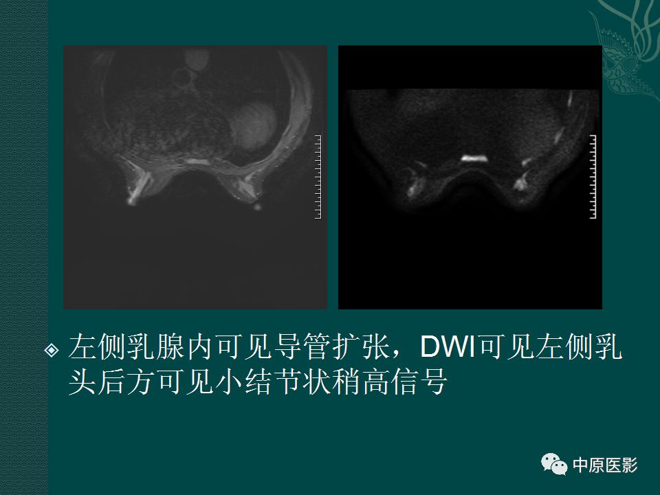 【PPT】乳腺导管内乳头状瘤MRI表现-23