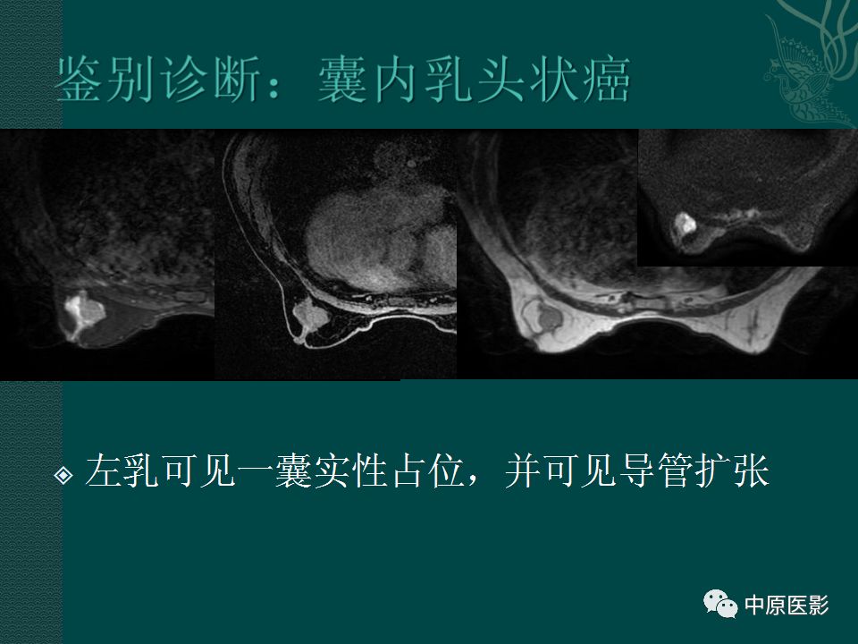【PPT】乳腺导管内乳头状瘤MRI表现-38