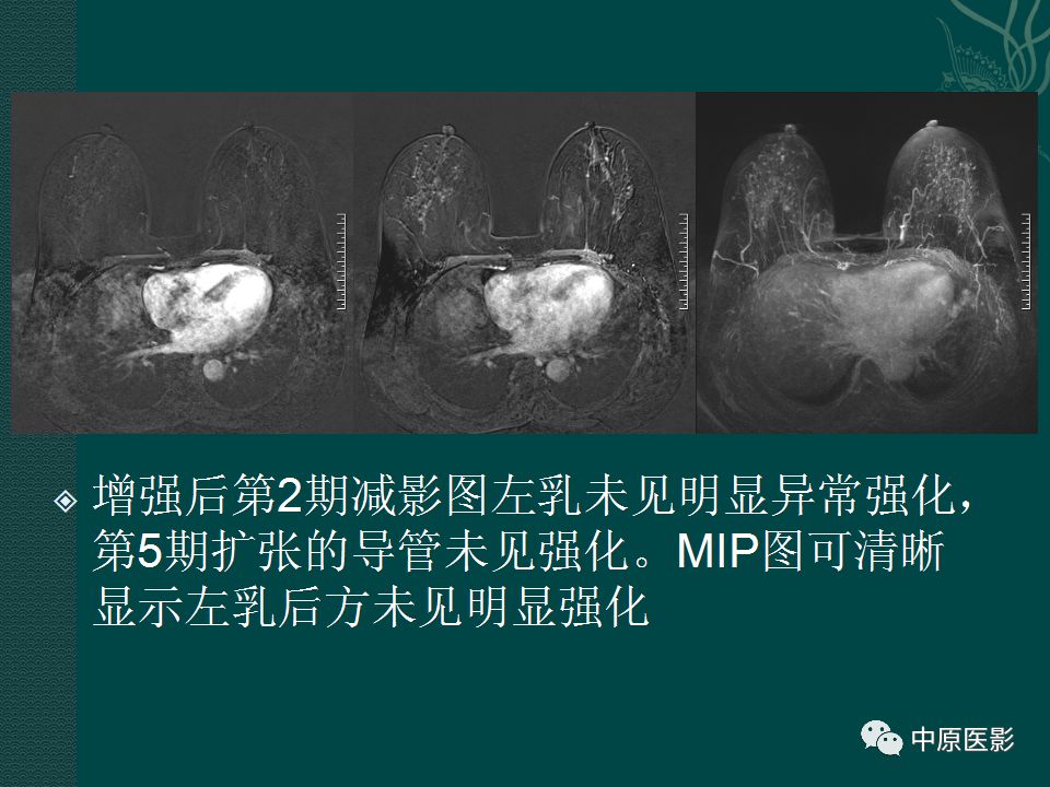 【PPT】乳腺导管内乳头状瘤MRI表现-43