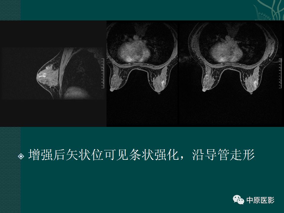 【PPT】乳腺导管内乳头状瘤MRI表现-31