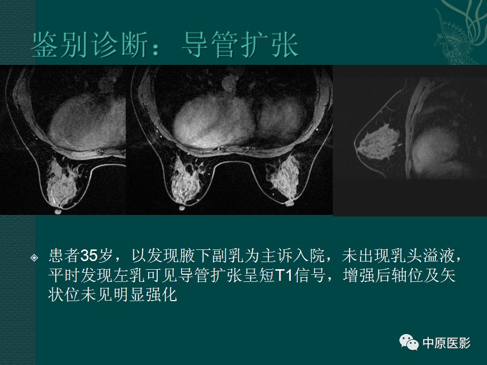 【PPT】乳腺导管内乳头状瘤MRI表现-44