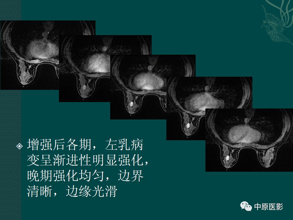 【PPT】乳腺导管内乳头状瘤MRI表现-26