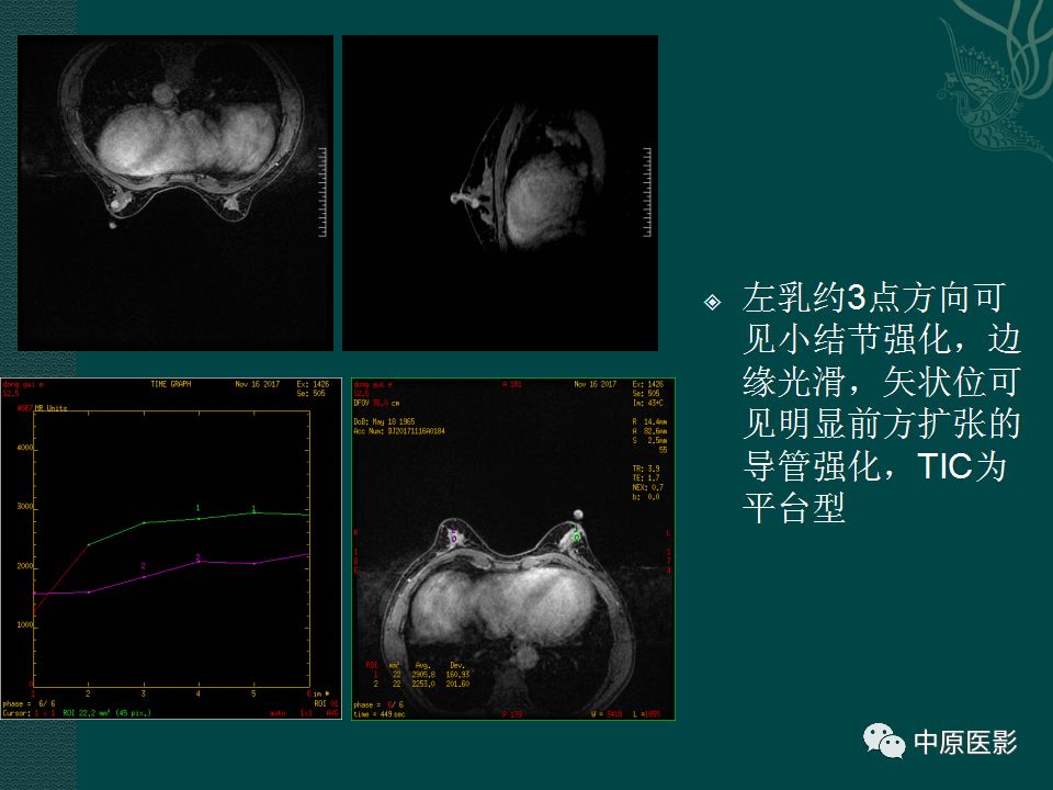 【PPT】乳腺导管内乳头状瘤MRI表现-24