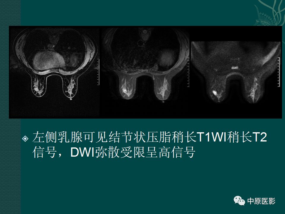 【PPT】乳腺导管内乳头状瘤MRI表现-17