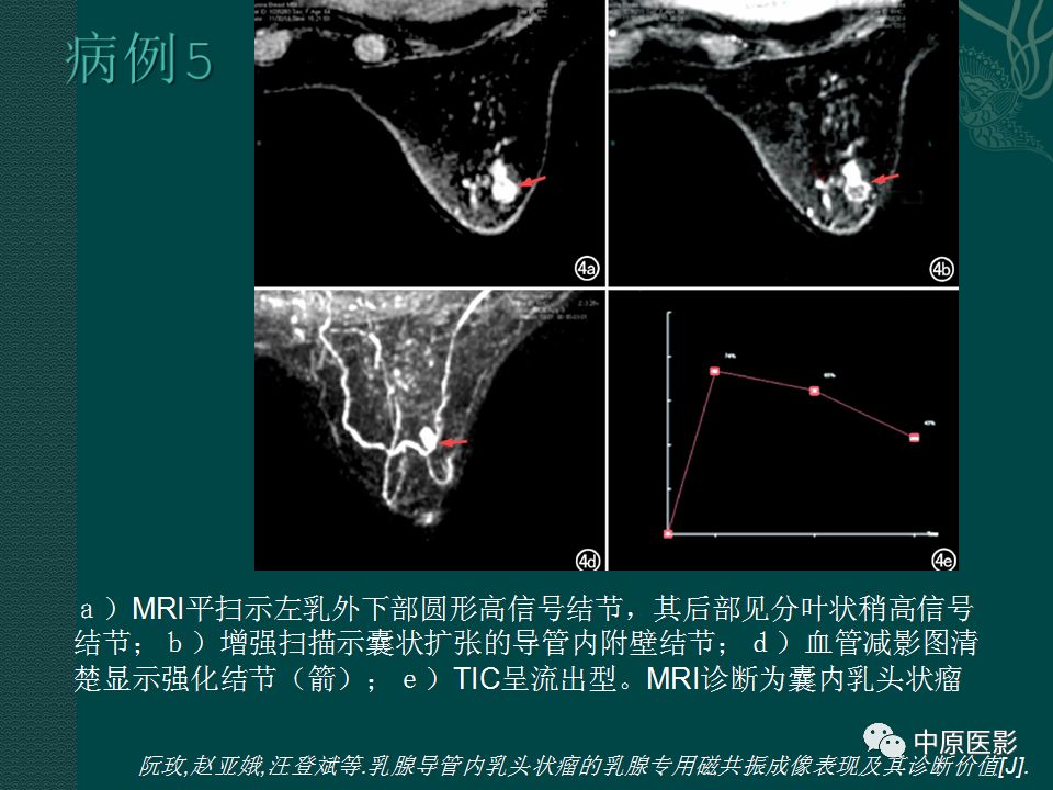 【PPT】乳腺导管内乳头状瘤MRI表现-37