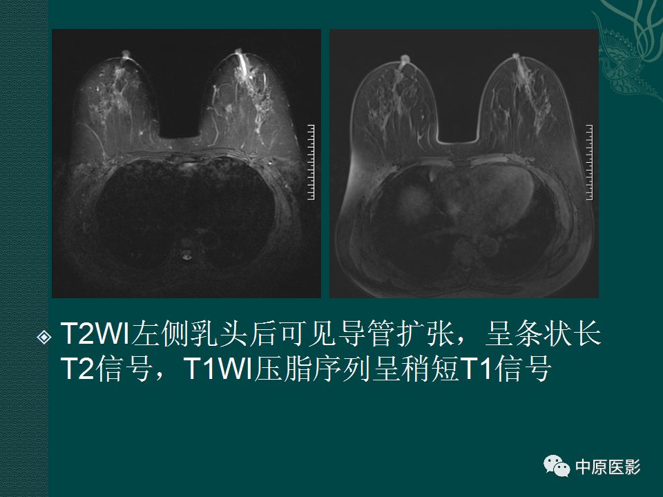 【PPT】乳腺导管内乳头状瘤MRI表现-42