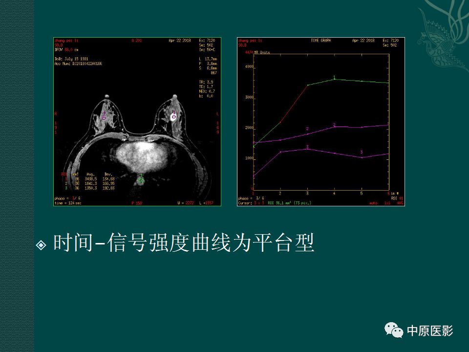 【PPT】乳腺导管内乳头状瘤MRI表现-27