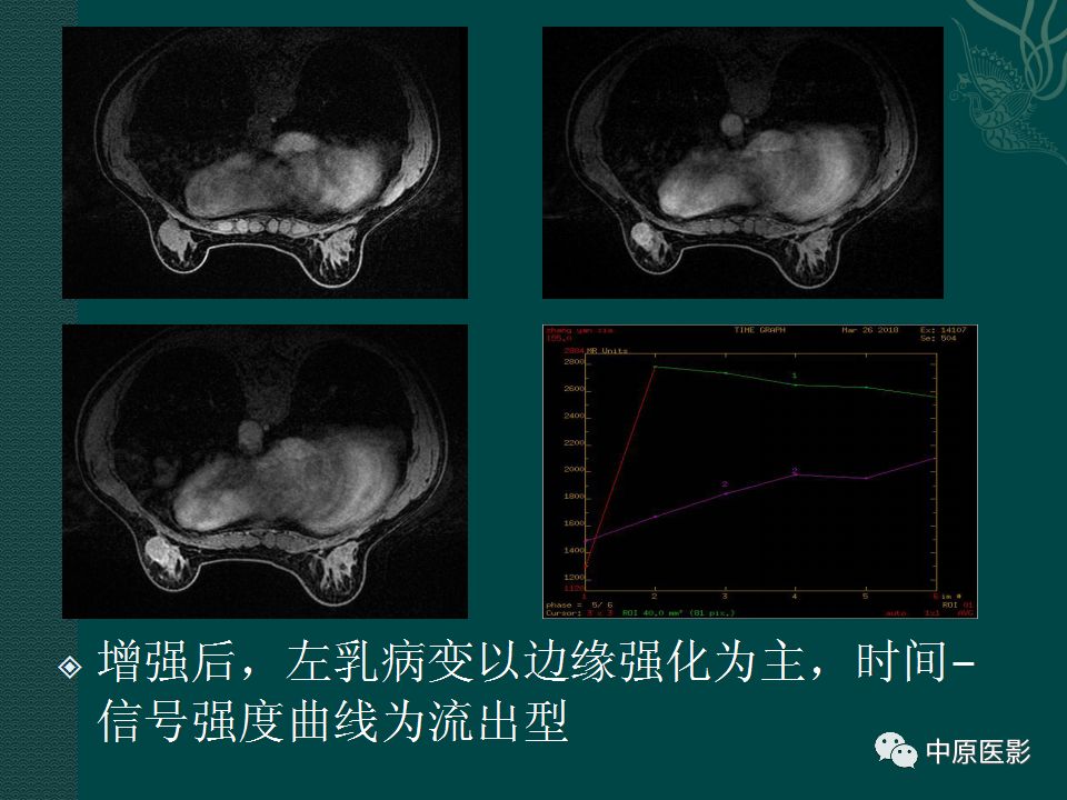 【PPT】乳腺导管内乳头状瘤MRI表现-20
