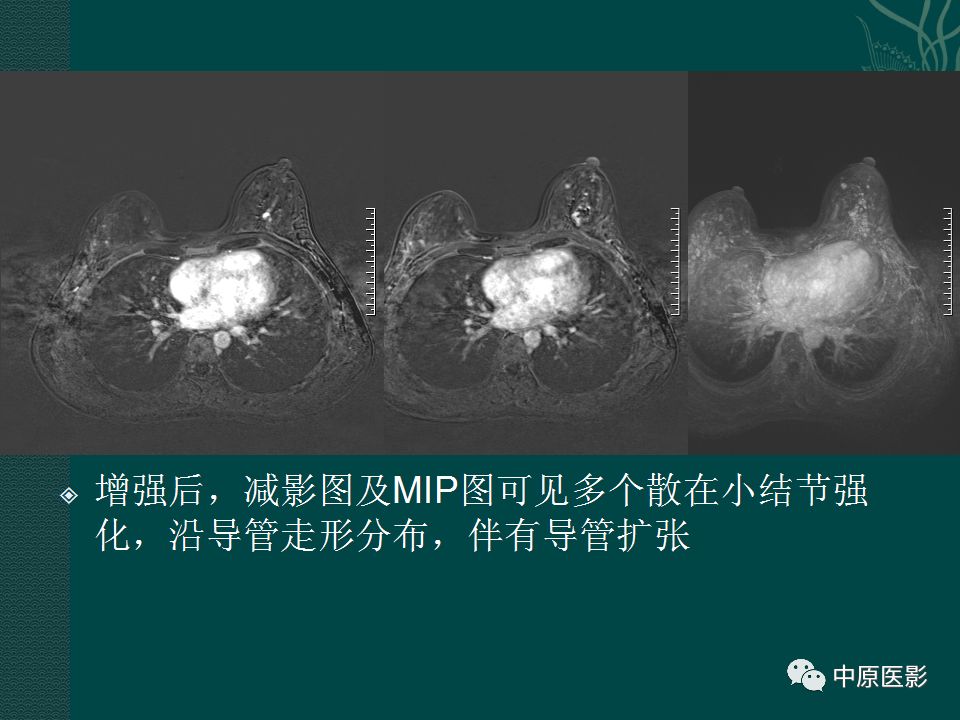 【PPT】乳腺导管内乳头状瘤MRI表现-34