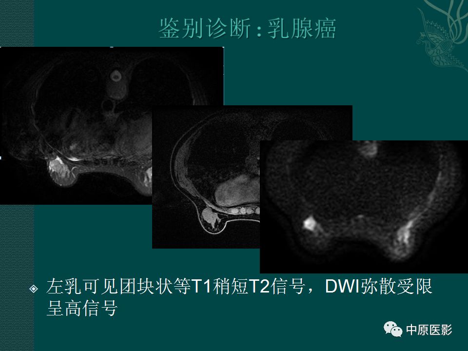 【PPT】乳腺导管内乳头状瘤MRI表现-19