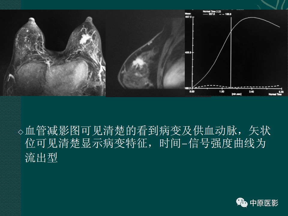 【PPT】乳腺导管内乳头状瘤MRI表现-47