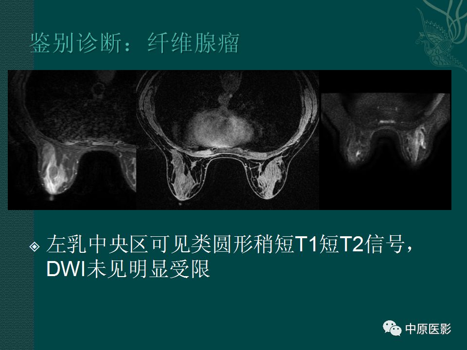 【PPT】乳腺导管内乳头状瘤MRI表现-25