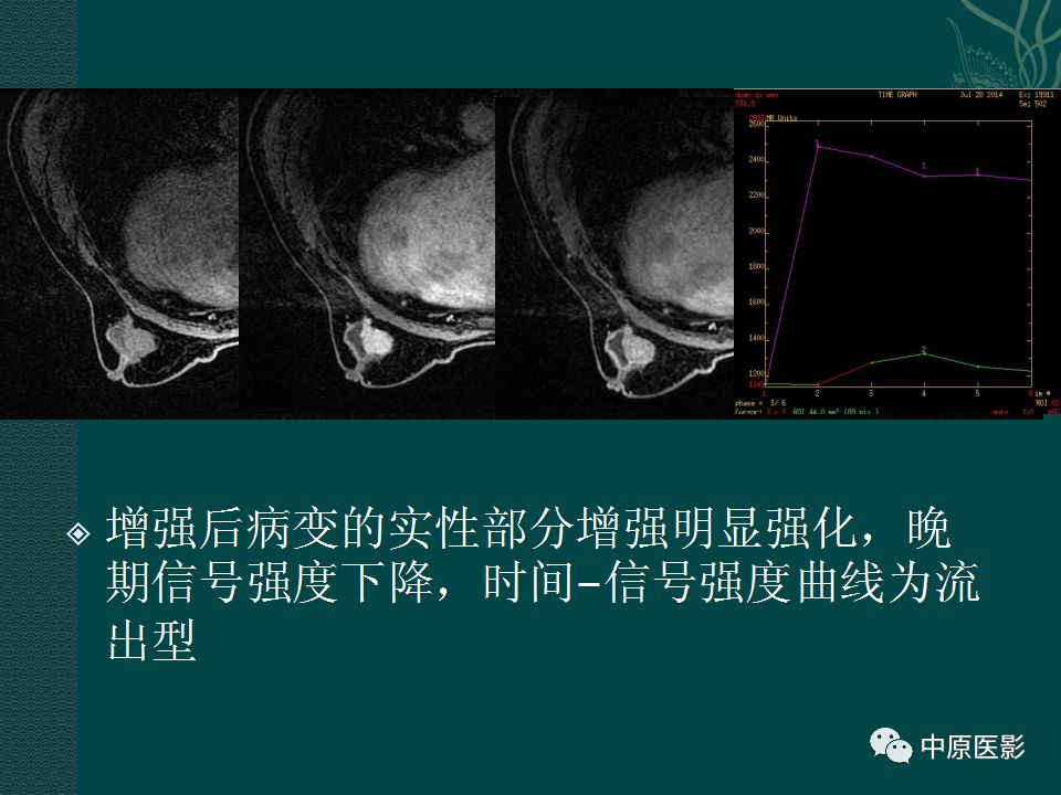 【PPT】乳腺导管内乳头状瘤MRI表现-39