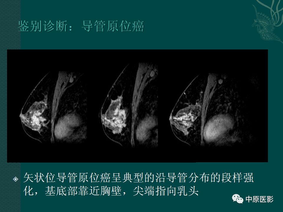 【PPT】乳腺导管内乳头状瘤MRI表现-35