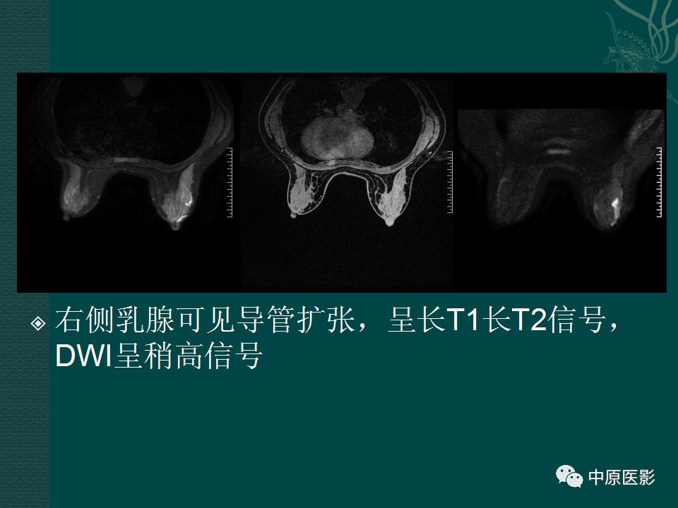 【PPT】乳腺导管内乳头状瘤MRI表现-30