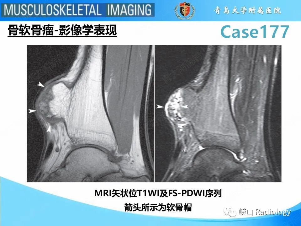 【PPT】骨软骨瘤-恶变-9