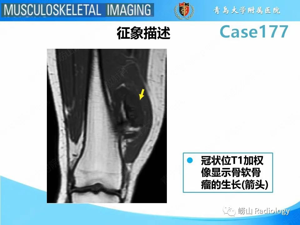 【PPT】骨软骨瘤-恶变-14