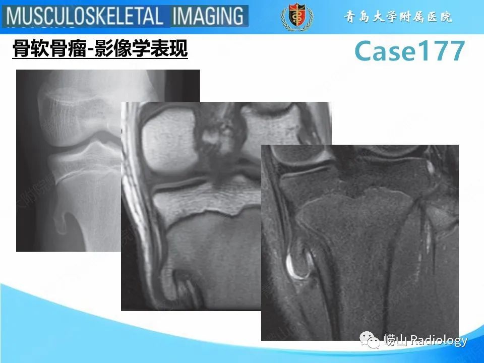 【PPT】骨软骨瘤-恶变-8