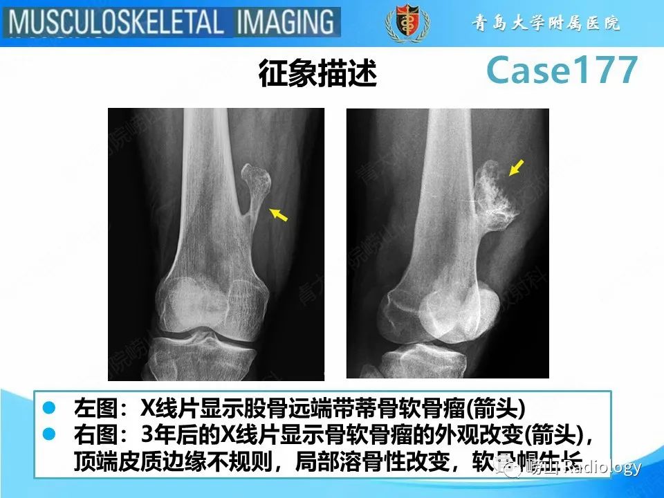 【PPT】骨软骨瘤-恶变-13