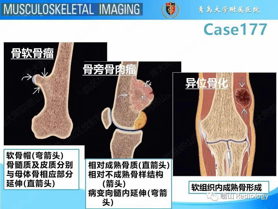 【PPT】骨软骨瘤-恶变-5