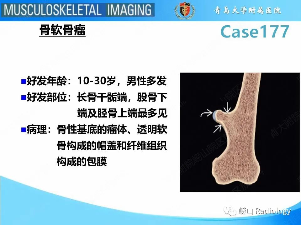 【PPT】骨软骨瘤-恶变-6