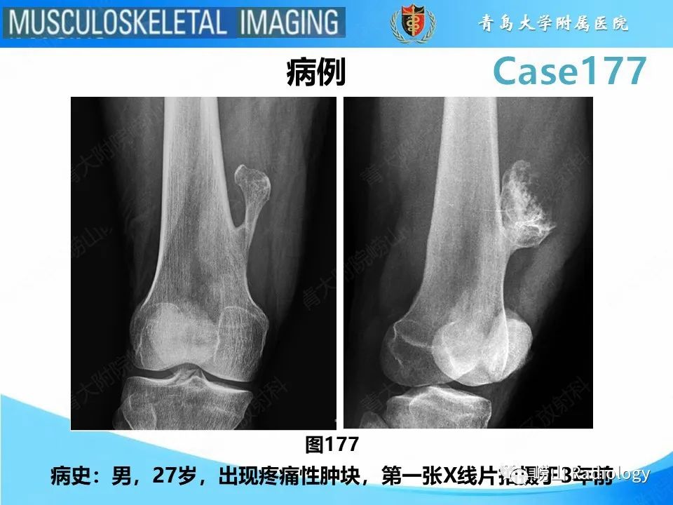 【PPT】骨软骨瘤-恶变-2