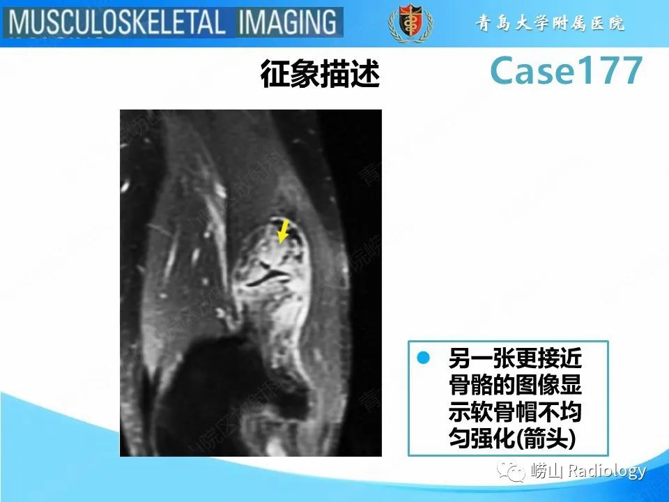 【PPT】骨软骨瘤-恶变-16