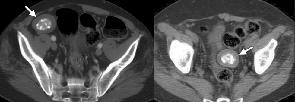 腹盆腔CT上常常遇到的会跑的病灶，它究竟是谁？-2