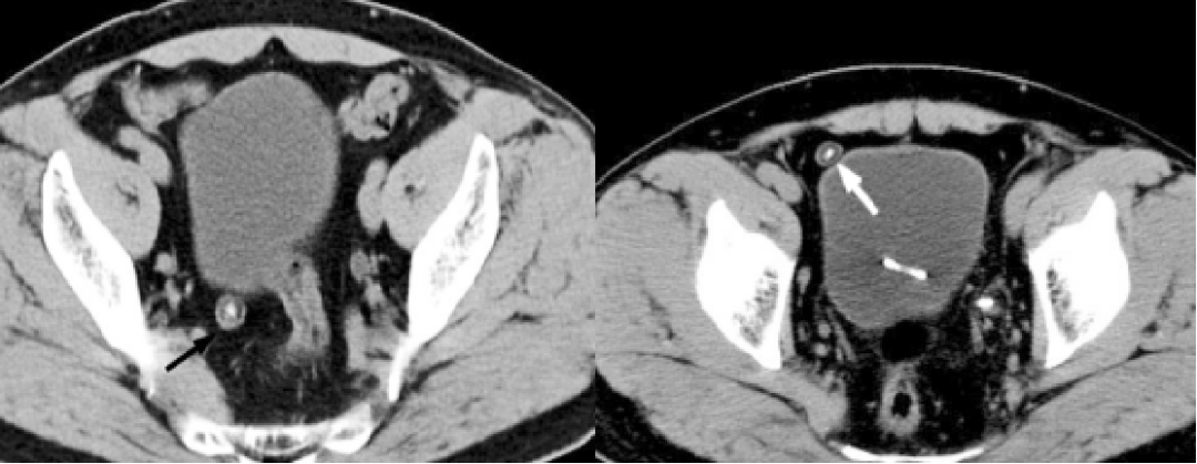 腹盆腔CT上常常遇到的会跑的病灶，它究竟是谁？-4