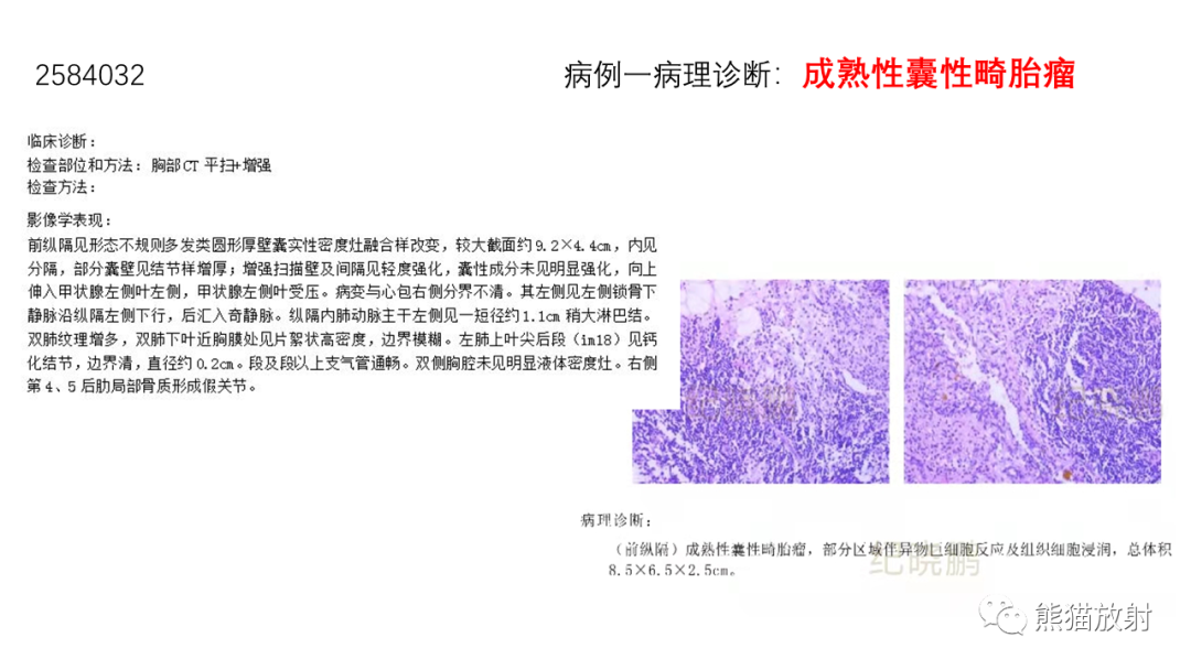 【病例】前纵隔畸胎瘤2例CT影像-16