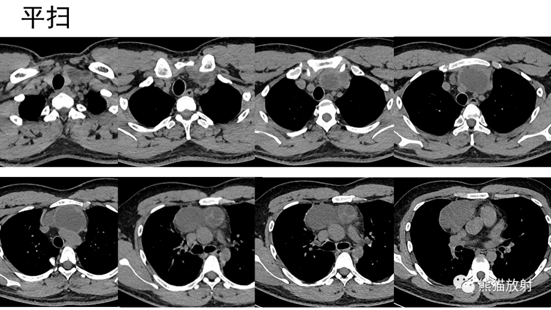 【病例】前纵隔畸胎瘤2例CT影像-4